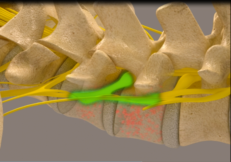 Disc Recovery Phase